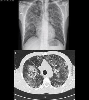 A) Rayos X de tórax con infiltrados difusos en ambos campos pulmonares. B) Opacidades mixtas generalizadas observadas en tomografía de tórax de alta resolución.