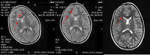 MRI investigation of the brain (A) before Tz treatment, (B) MRI investigation of the brain in 12 months Tz treatment and (C) MRI investigation of the brain in 26 months Tz treatment.