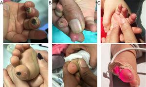 Ischemic lesions at the admission (A), at the 13th (B) and at the 21st day (C) of therapy with intravenous iloprost.