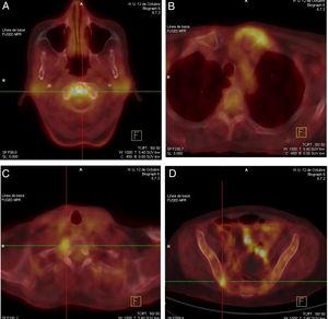 Hipercaptación del radiofármaco (18F-FDG) en PET-TC a nivel de las articulaciones atloaxoidea (A), esternoclavicular izquierda (B), costovertebral derecha de T1 (C) y sacroiliaca derecha (D).