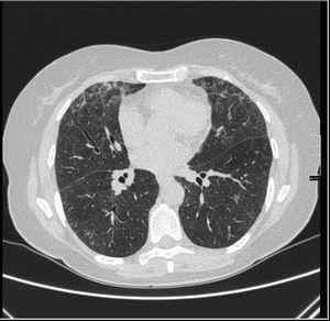 Tomografía computarizada de alta resolución. Corte axial a nivel de bases pulmonares. Se observa patrón de vidrio deslustrado que corresponde a neumonía aguda/subaguda. No se observan áreas de fibrosis ni distorsión de la arquitectura pulmonar.
