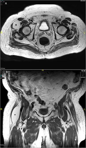 Lesión ovoidea (*) entre el vientre del músculo tensor de la fascia lata y el músculo sartorio. A)RMN de cadera, plano axial. B)RMN de cadera, plano coronal.