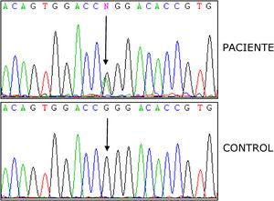 Mutación p.R92Q en heterocigosis. Exón 4, gen TNFRSF1A.