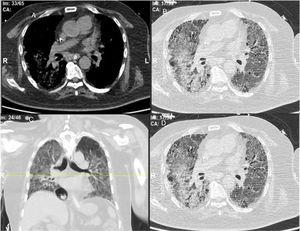 (A) Mediastinal window; (B, C) axial high-resolution lung window; (D) coronal reconstruction (lung window) showing extensive areas of ground glass veiling andopacification together with interstitial sub-pleural infiltrates (interstitial pneumonia and infiltrates).
