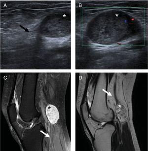 Ultrasound (A, B) and MRI (C, D) images of the knee depicting a well-defined solid mass (*) localized in the popliteal region, originating from the tibial nerve (arrows), with a heterogeneous structure with low intensity MRI-signal on T1 sequences and high intensity on DP SPAIR (C) and T2 sequences (D).