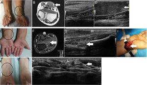 Clinical case 1. A: Swelling of the forearm (circle); B: Magnetic resonance imaging showing a muscle mass, which may correspond to the anatomical variant (arrow); C: Ultrasound of normal forearm; D: Ultrasound of accessory flexor digitorum superficialis indicis muscle (arrow). Clinical case 2. E: Swelling of the forearm (circle); F: Magnetic resonance imaging showing mild hypersignal of the pronator quadratus (arrow); G: Ultrasound showing a hypoechoic mass (arrow); H: Ultrasound of normal forearm; I: Surgical exploration that revealed a lipoma. Clinical case 3. J: Swelling of the forearm (circle); K: Ultrasound of normal forearm; L: Ultrasound of a hypoechoic mass that compressed the median nerve, suggestive of lipoma or muscle mass (arrow).