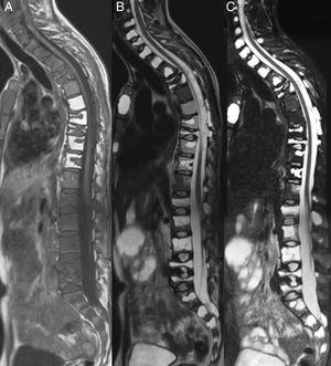 Imágenes de RM donde se visualizan múltiples aplastamientos vertebrales con hipercifosis secundaria, en el plano sagital de la columna cervical, dorsal y lumbar potenciadas en T1 (A), TT2 (B) y STIR (C). Múltiples lesiones que se comportan hipointensas en T1 e hiperintensas en TT2-STIR con distribución difusa.