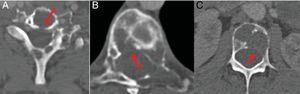 TC con ventana de hueso de columna cervical, dorsal y lumbar. Múltiples lesiones líticas con destrucción de la cortical ósea (flechas). A) En el margen posterior del cuerpo vertebral C6. B) En el margen posterolateral derecho del cuerpo vertebral T8. C) En el margen posterolateral izquierdo del cuerpo vertebral L3.