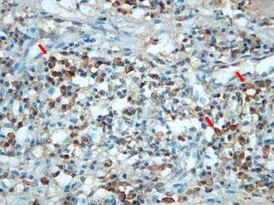 Biopsy of the sternal lesion with immunohistochemical staining for IgG4 shows IgG4 positive plasma cells (arrows).
