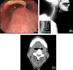An extrinsic posterior hypo-pharyngeal mass covered by normal mucosa was found at presentation (A, arrow). Pharyngeal compression by ossification of the anterior longitudinal ligament at the level of C3–C4 on a lateral cervical spine radiograph (B, arrow) and at the level of C4 in the axial plane of a computed tomography scan image at presentation (C, arrow). The distance between the tip of the osteophyte and the anterior vertebral margin was 13mm (B, lower left).