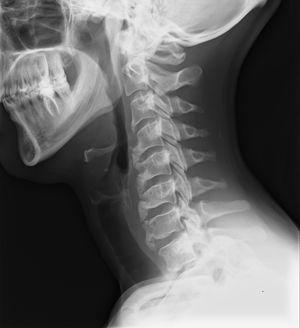 lateral cervical spine X-RAY shows ossification along the anterior aspect of the vertebral bodies from C3 to C7, preservation of disc height in the involved levels and the absence of bony ankylosis of facet joints.