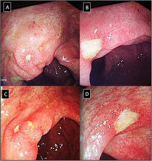 (A–D) Lower gastrointestinal endoscopy showing colonic ulceration in a patient with undifferentiated spondyloarthritis presented with acute asymmetrical oligoarticular synovitis of lower limbs and gastrointestinal symptoms highly suggestive of inflammatory bowel disease over two weeks duration. The estimated faecal calprotectin (FCP) at disease onset is 550μg/g (normal values <50μg/g).