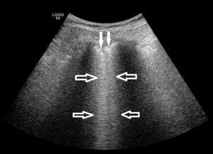 Imagen ecográfica del pulmón en una paciente con EPID. Se detectan los artefactos denominados líneas B (flechas huecas) y un engrosamiento irregular de la pleura (flechas sólidas), ambos hallazgos indicativos de las alteraciones alvéolo-intersticiales y pleurales que se producen en las EPIS.