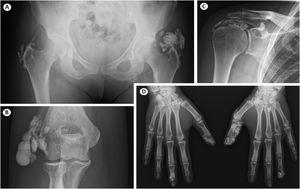 Calcinosis cutis in systemic sclerosis. X-rays show soft tissue calcium deposits in hips (A), right elbow (B), right shoulder (C) and fingers (D).