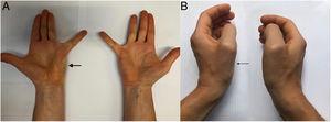 Atrophy of the abductor digiti minimi muscle (A, thick arrow) and abductor pollicis brevis muscle (B, thin arrow).