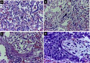 DAD. (A, B) Smudge cells (H&E 400×). (C) Myofibroblastic proliferation in alveolar walls (H&E 400×). (D) Squamous metaplasia in pneumocytes (H&E 400×).