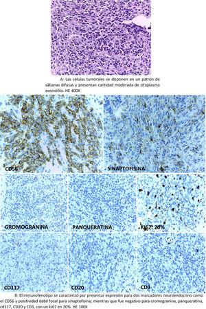 A: Las células tumorales se disponen en un patrón de sábanas difusas y presentan cantidad moderada de citoplasma eosinófilo. HE 400X. B: El inmunofenotipo se caracterizó por presentar expresión para 2 marcadores neuroendocrino como el CD56 y positividad débil focal para sinaptofisina; mientras que fue negativo para cromogranina, panqueratina, cd117, CD20 y CD3, con un ki67 en 20%. HE 100X.