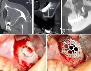 (A) TC axial, (B) TC coronal, (C) TC sagittal, (D) Calwell-Luc approach and (E) reconstruction of the sinus anterior wall with a titanium mesh.
