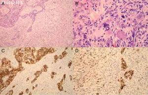 The tumor was composed of two different malignant components, carcinoma (left) and sarcoma (right) (A, ×100, HE). The sarcomatous component morphologically corresponded to malignant fibrous histiocytoma (B, ×400, HE). Immunohistochemically, the carcinoma was positive for HER2 (C, ×100, HER2). p53 showed focal, nuclear positivity in both malignant components (D, ×200, p53).