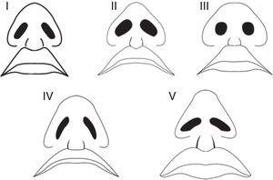 Nostril models in young Turkish females.
