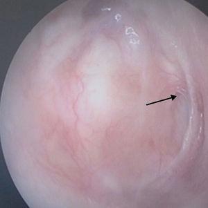 Perforation between remnant tympanic membrane and cartilage part of the graft seven months after the operation.