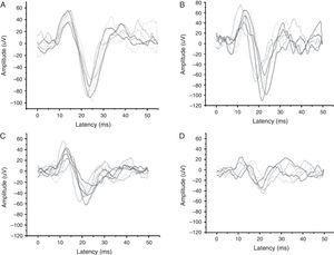 Records of vestibular evoked myogenic potential wave tracings by tone-burst stimuli frequency.