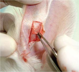 Horizontal incisions performed with folded skin and perichondrium removal.