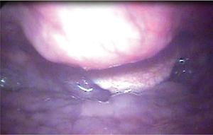 Video laryngoscopy image of a patient with Forestier’s disease, showing submucosal bulging in hypopharynx, corresponding to prominent cervical osteophytes.