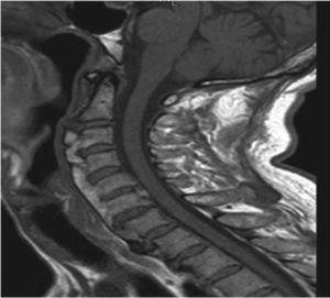Magnetic resonance images of the cervical spine in T1 showing calcification of the anterior longitudinal ligament, with no involvement of nervous structures.