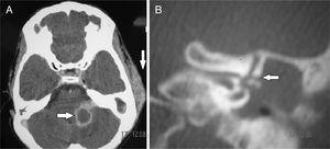 (A) Axial CT scan showing cerebellar abscess and subperiosteal abscess. (B) Coronal CT scan showing labyrinthine fistula at the same patient.