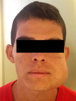 Clinical findings. Front view of the patient showing marked facial asymmetry.