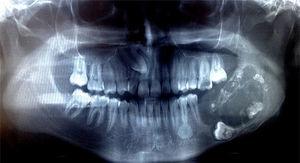 Panoramic radiograph showing multilocular extensive radiolucent lesion with radiopaque foci in the left mandible, associated with impacted molar (36).