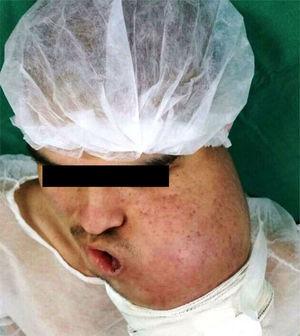 Craniocaudal view of the patient showing a significant increase in tumor mass after eight sessions of chemotherapy.