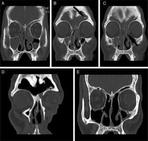 Inverted papilloma originating from the left ethmoid sinus invading the ...