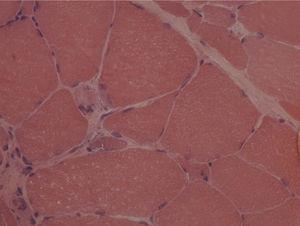Presence of polygonal muscular atrophy and rimmed vacuoles (hematoxylin–eosin stain, 350×).