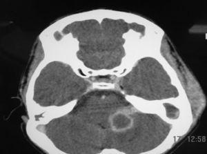Brain CT with contrast, axial view and soft tissue window. It shows a cerebellar abscess on the left. Note: soft tissue edema, adjacent to the left temporal bone, consistent with mastoiditis.