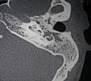 Left temporal bone CT, axial view, showing cochlear ossification. Note: underdeveloped mastoid filled with soft tissue-density material.