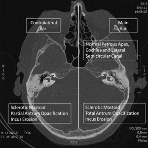 Tomographic evaluation of the contralateral ear in patients with severe ...