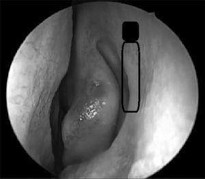 Endoscopic view of the left-side nasal cavity. The black rectangle shows the preciously accepted incorrect extension of the lacrimal sac. The shaded area shows the correct position with its superior extension in average 8 mm above the middle concha insertion.