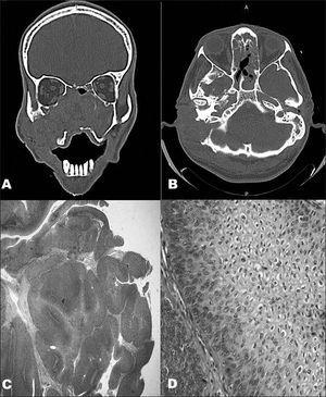 A and B: CT scans of the nose, paranasal sinuses, and mastoid: tumor-like lesion with soft tissue attenuation invading the nasal fossae, the maxillary, ethmoid, and sphenoid sinuses, the rhinopharynx, the right medial orbit wall, and the ipsilateral mastoid, accompanied by massive lysis of the adjacent bone structures. C: Microscope image showing an IP: papillomatous proliferation of the squamous epithelium with endophytic growth pattern (40x - HE). D: Microscope image revealing endophytic projection of the squamous epithelium with preserved cell architecture containing various koilocytes (400x - HE).