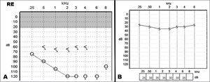 A: pre-operative right ear audiogram showing profound sensorineural hearing loss. B: 6 months postoperative audiometric evaluation with cochlear implant demonstrates threshold of 30 dB.