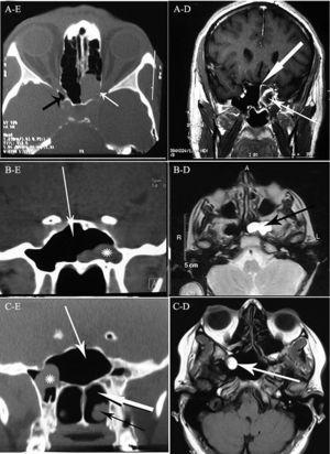 A: (Vlevo) axiální CT scan dutin ukazuje kompletní opa-cification levé sphenoid sinus s dehiscence v levém zrakový kanál (bílá šipka), opticocarotid vybrání (černá šipka); (Vpravo) MRI ukazuje cysta s okrajem vylepšení bránění dutiny ústí (tenká šipka), silná šipka ukazuje zvýšenou sphenoid sinus sliznice. B: (Vlevo) koronální CT scan dutin ukazuje retenční cysta (astrix) v bočním výklenku sphenoid sinus, bílá šipka ukazuje, sphenoid sinus; (Vpravo) MRI vážená T2 ukazuje hyperintenzivní retenční cystu levého sfénoidního sinu (černá šipka). C: (Vlevo) koronální CT ukazuje, sphenoid sinus (bílá tenká šipka) a retenční cysta (astrix) bez vyvíjen tlak na chiasma opticum, zadní chornea (tlusté bílé šipky) a dolní skořepy (černá šipka); (Vpravo) MRI ukazuje hyper-intenzivní hmoty v sphenoid sinus a jeho boční vybrání (bílá šipka).