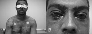 A: Cyanosis of the upper third of the chest extending to the neck and head. B: Bilateral subconjunctival hemorrhage.
