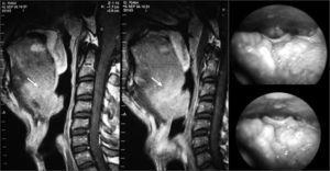 Lingual tonsil hyperplasia - Laryngoscopic and magnetic resonance images demonstrating lingual tonsil hyperplasia.