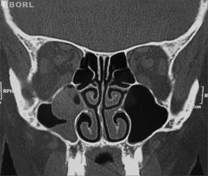 Oncocytic Papilloma | Brazilian Journal of Otorhinolaryngology