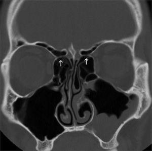 Anterior Ethmoidal Artery Evaluation on Coronal CT Scans | Brazilian ...