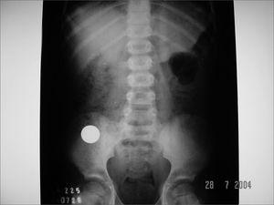 Case 5: 2.3cm coin that spontaneously descended to the gastrointestinal tract.