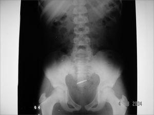 Case 6: 2.5cm coin that spontaneously descended to the gastrointestinal tract.