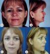 Subperiosteal Facelift: A 5-year Experience 