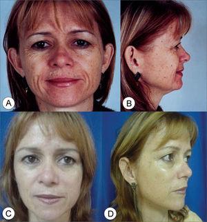 Subperiosteal facelift: a 5-year experience | Brazilian Journal of ...